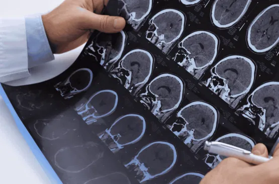 MULTIPLE SCLEROSIS