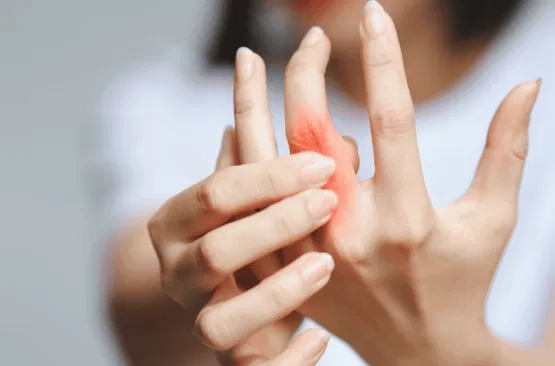 RHEUMATOID ARTHRITIS