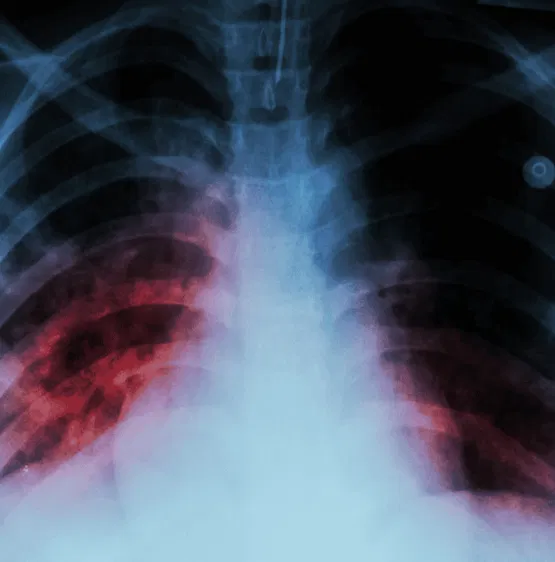 Pulmonary Deseases