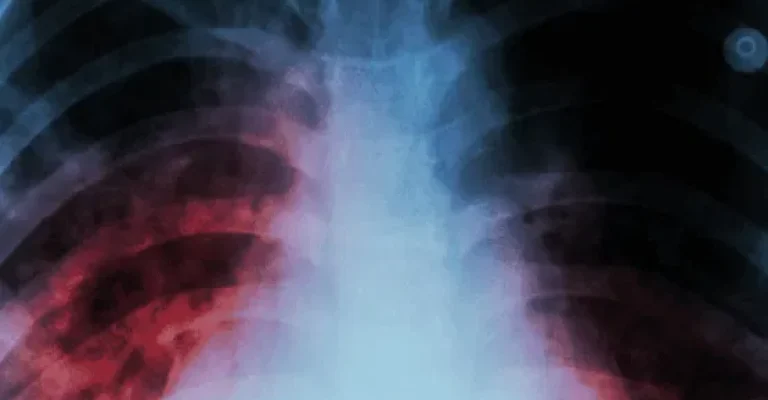 Diseñosintítulo(2)(1) Pulmonary Deseases