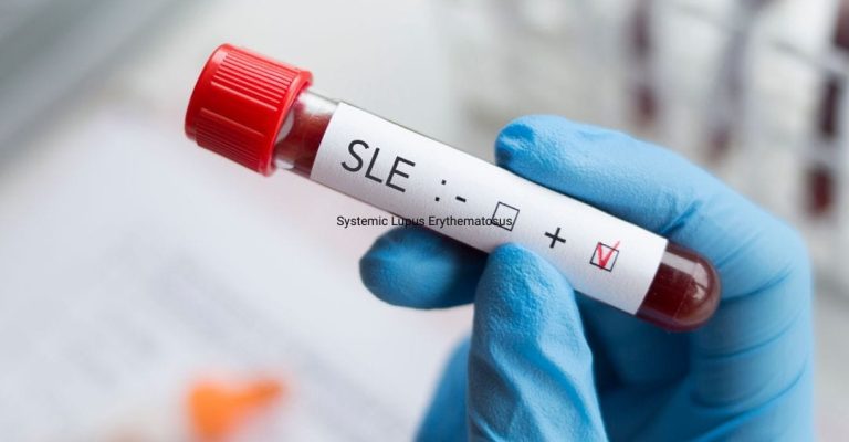 Systemic Lupus Erythematosus